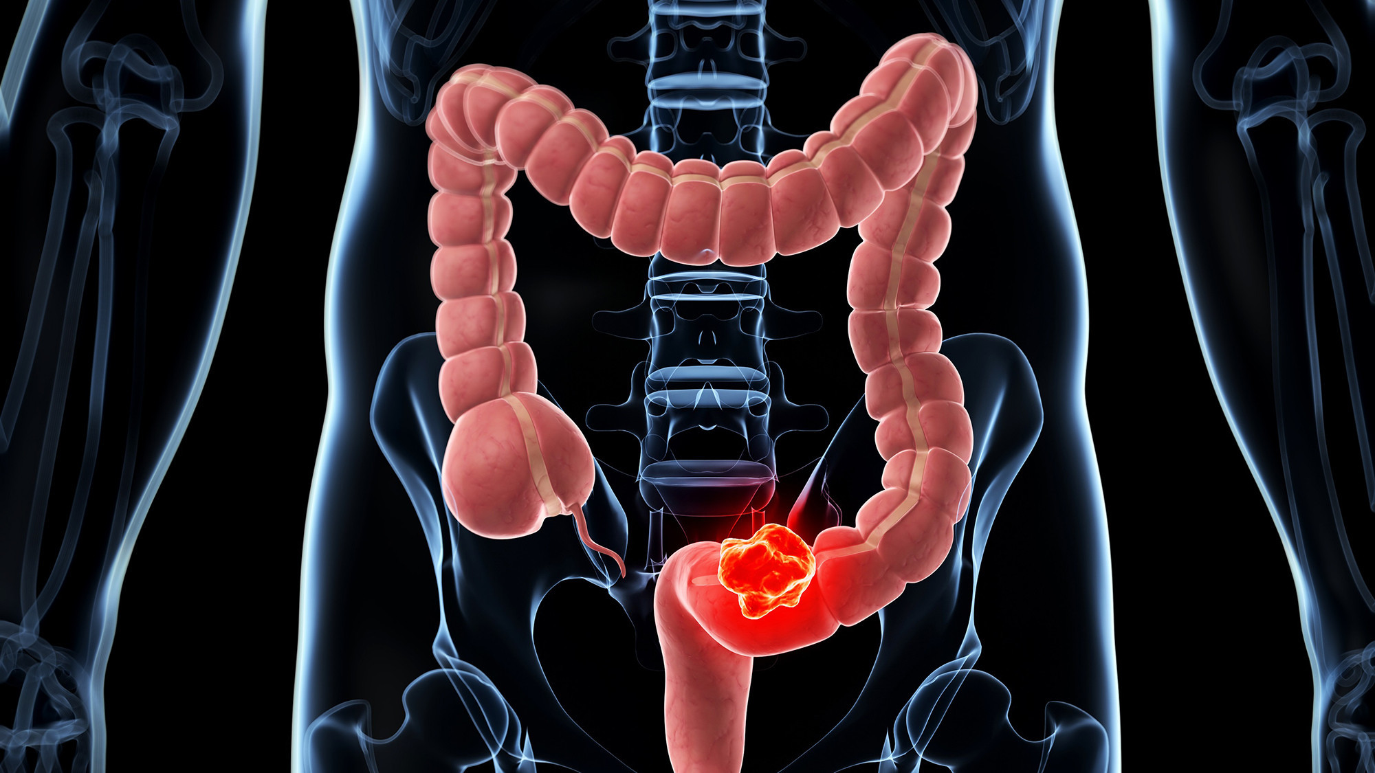 Vastagbélrák tünetei