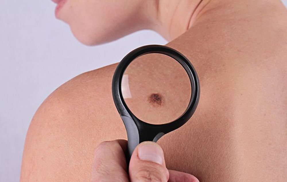 Így ismerd fel a bőrdaganatot!